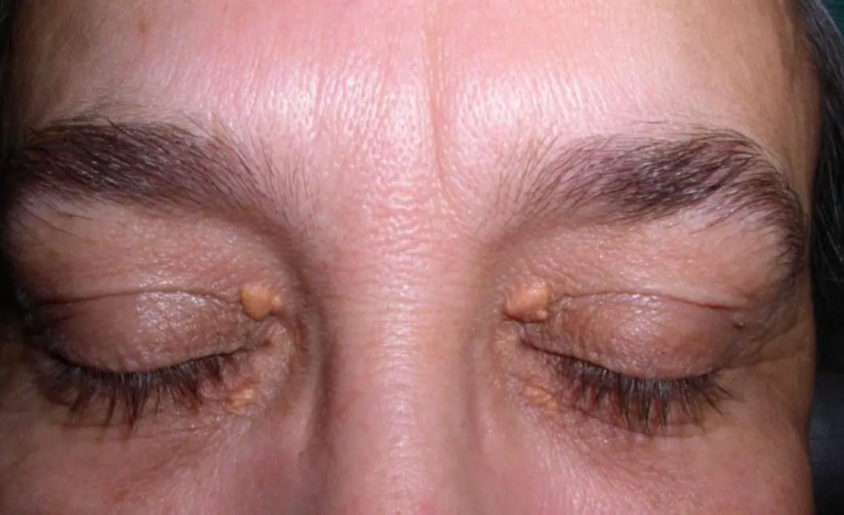 What Deficiency Causes Xanthelasma?