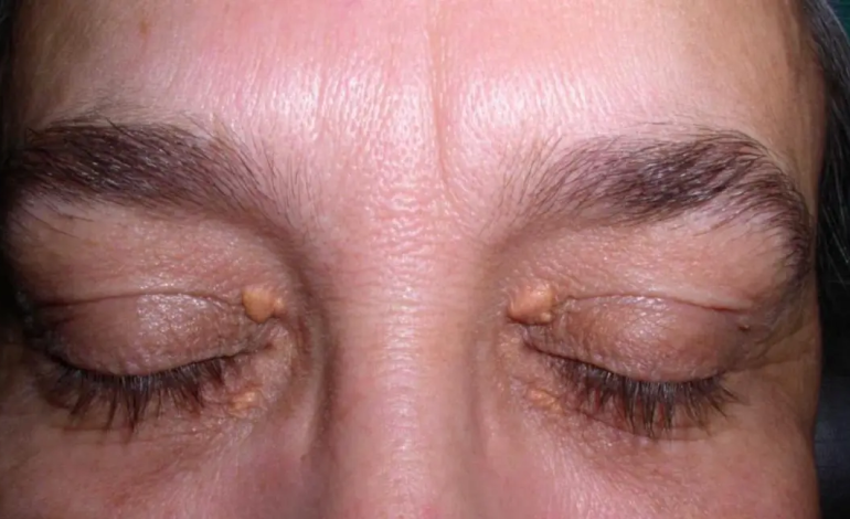 Xanthelasma