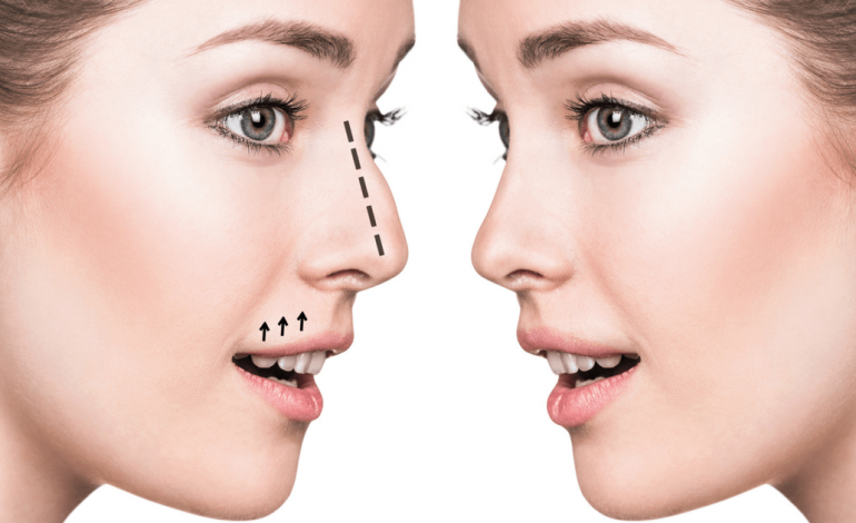 Nurturing Your Nose: Tips for Maintaining Rhinoplasty Results